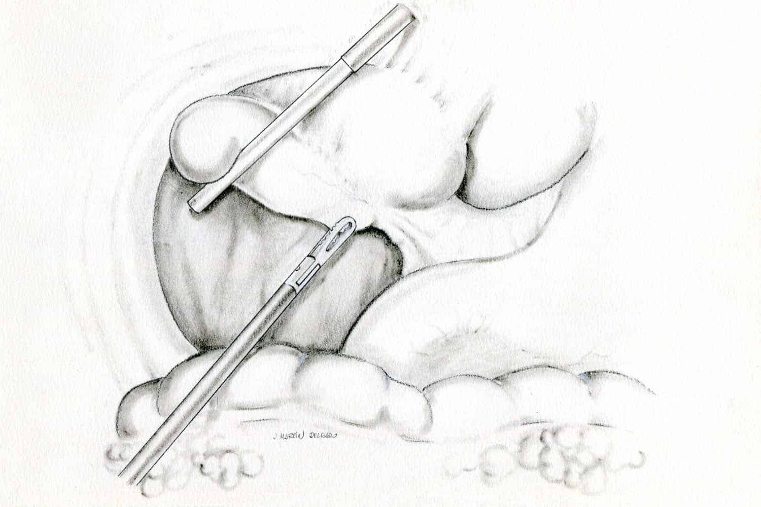 Foto dibujo intervención cirugía vesícula biliar