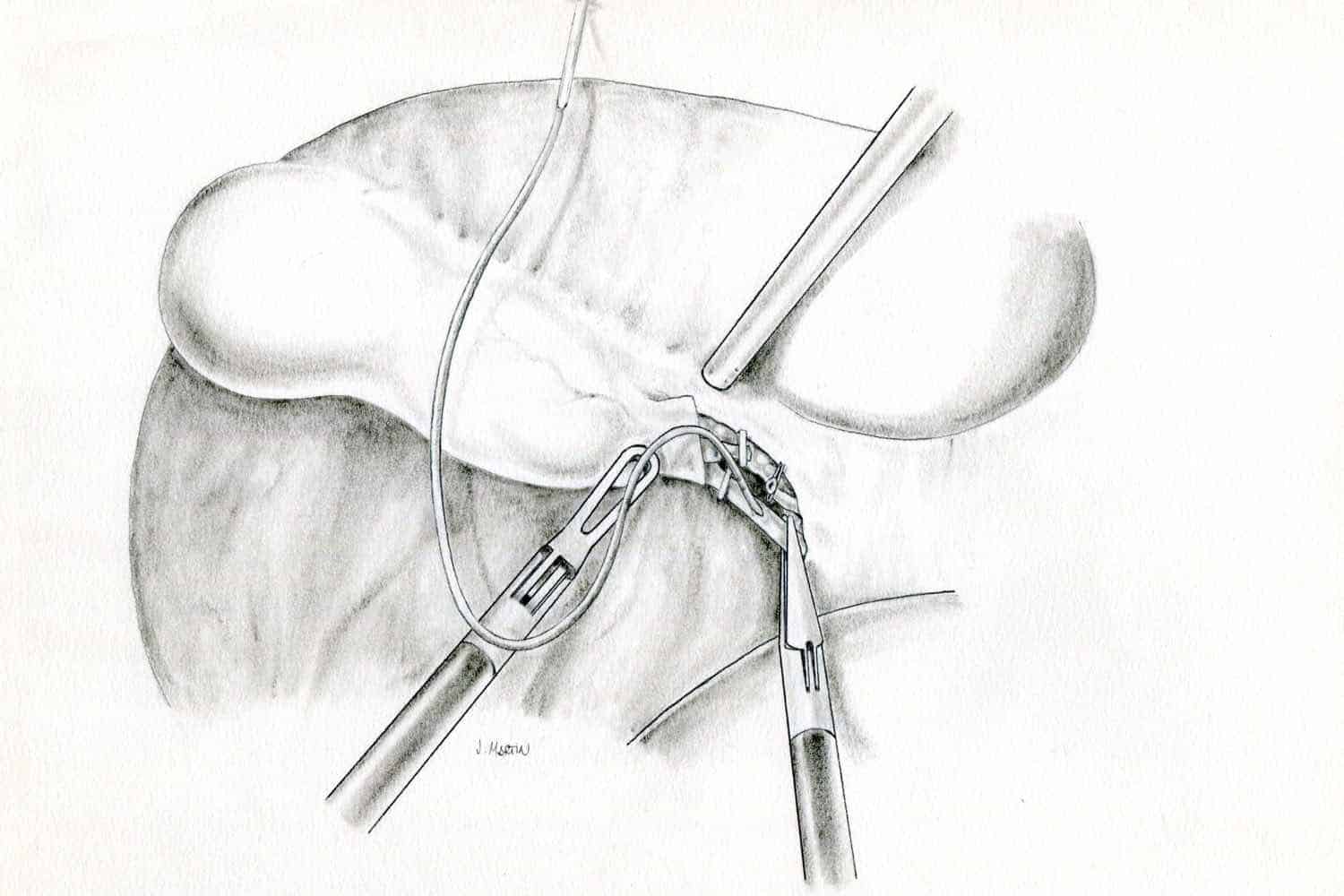 Foto dibujo intervención cirugía vesícula biliar