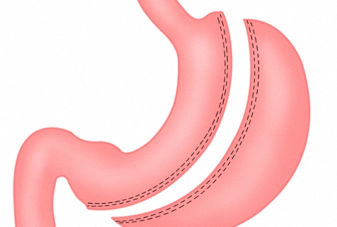 Esquema de la gastrectomía tubular
