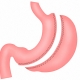 Esquema de la gastrectomía tubular
