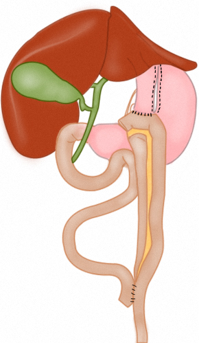 Esquema principal del bypass gastrico laparoscopico
